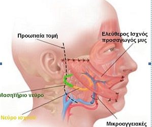 Άμεση αποκατάσταση σε απόλυτα ικανοποιητικό επίπεδο σε χρόνια παράλυση προσώπου
